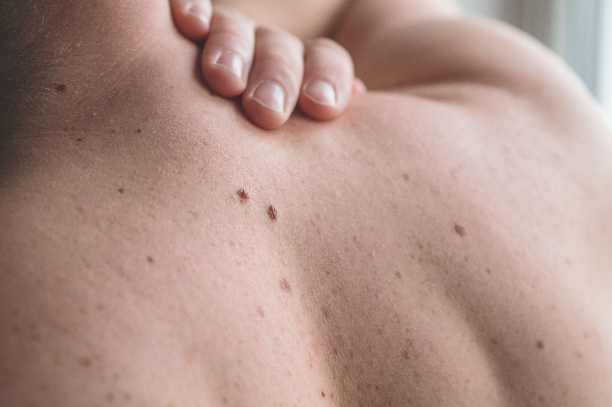Man's upper back with multiple moles during a professional mole mapping skin examination.
