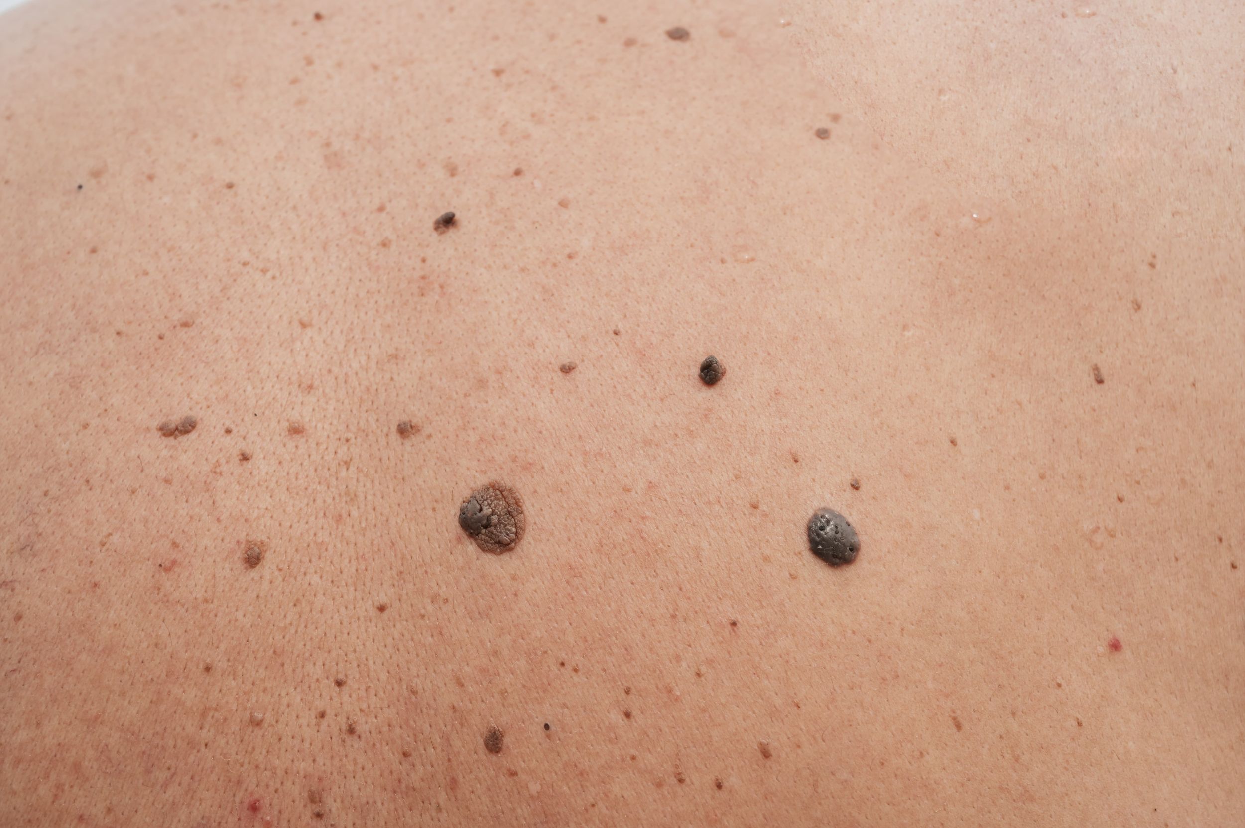 Close-up of raised moles and skin lesions during a dermatology assessment.