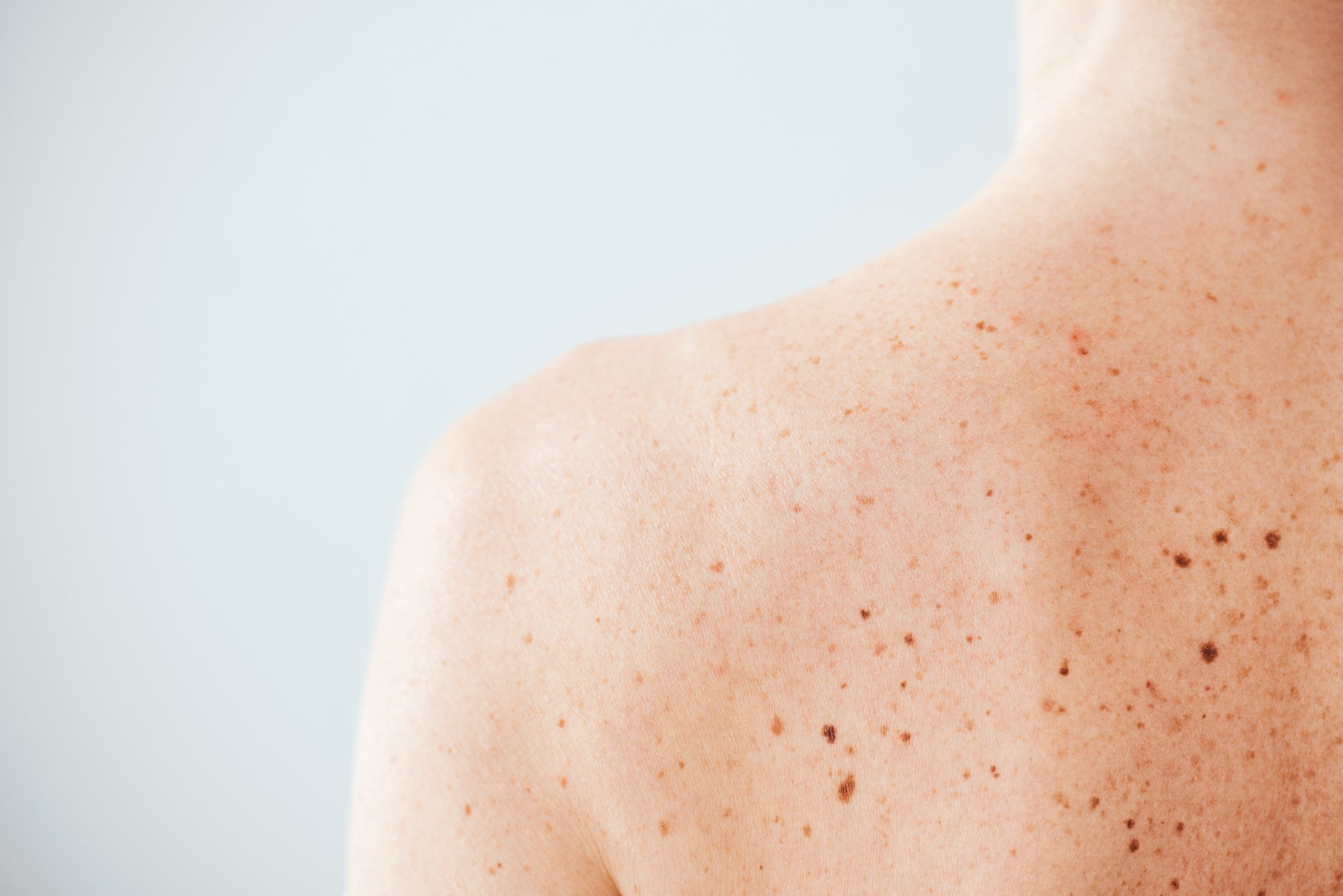 Close-up of skin with freckles and moles for a dermatology skin check.
