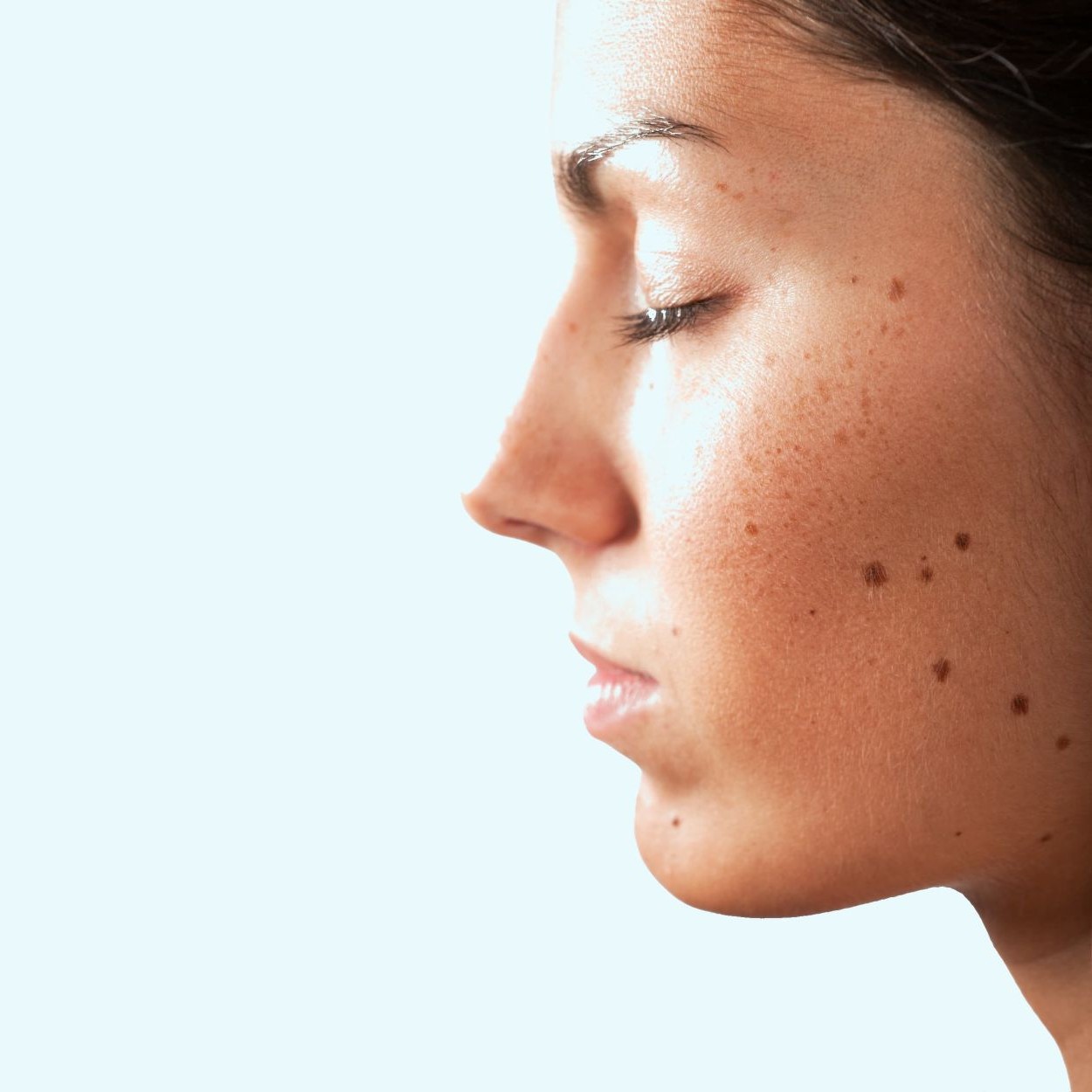 Side profile of a woman with facial moles photographed for digital mole mapping.