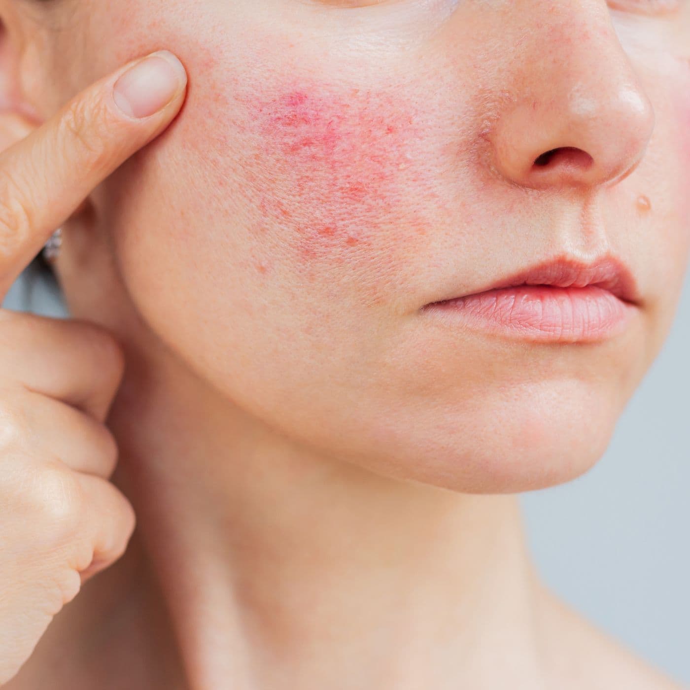 Close-up of a woman's cheek showing redness and rosacea assessed at Enigma Healthcare's private dermatology clinic in Tarporley, Cheshire