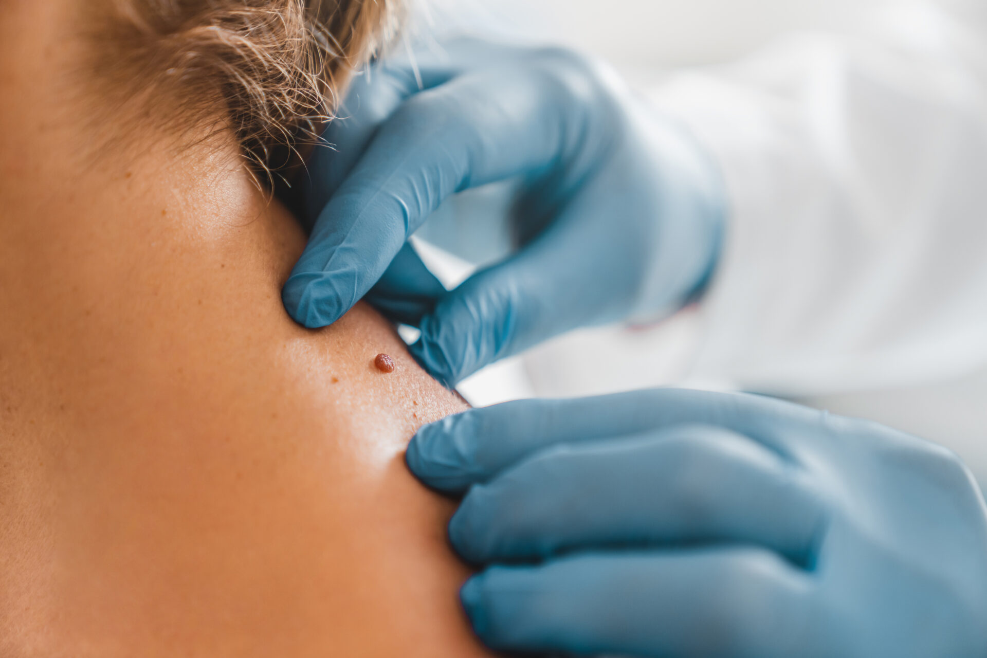 Consultant Dermatologist or GP examining a mole on a patient's shoulder during a private Mole Check in Cheshire