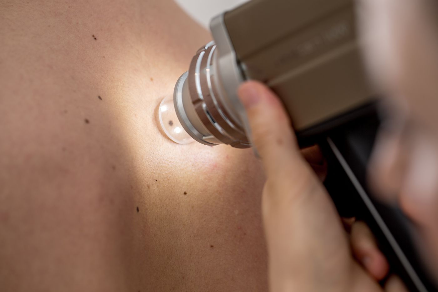 Consultant Dermatologist examining a mole using a dermatoscope during a private mole check at Enigma Healthcare in Cheshire.